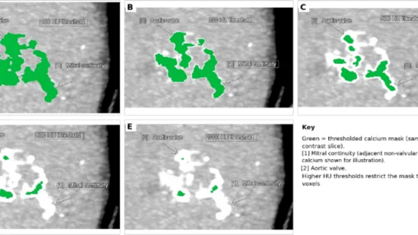 Hogere HU-drempels voegen geen waarde toe aan CT-calciumscoring voor aortaklepstenose