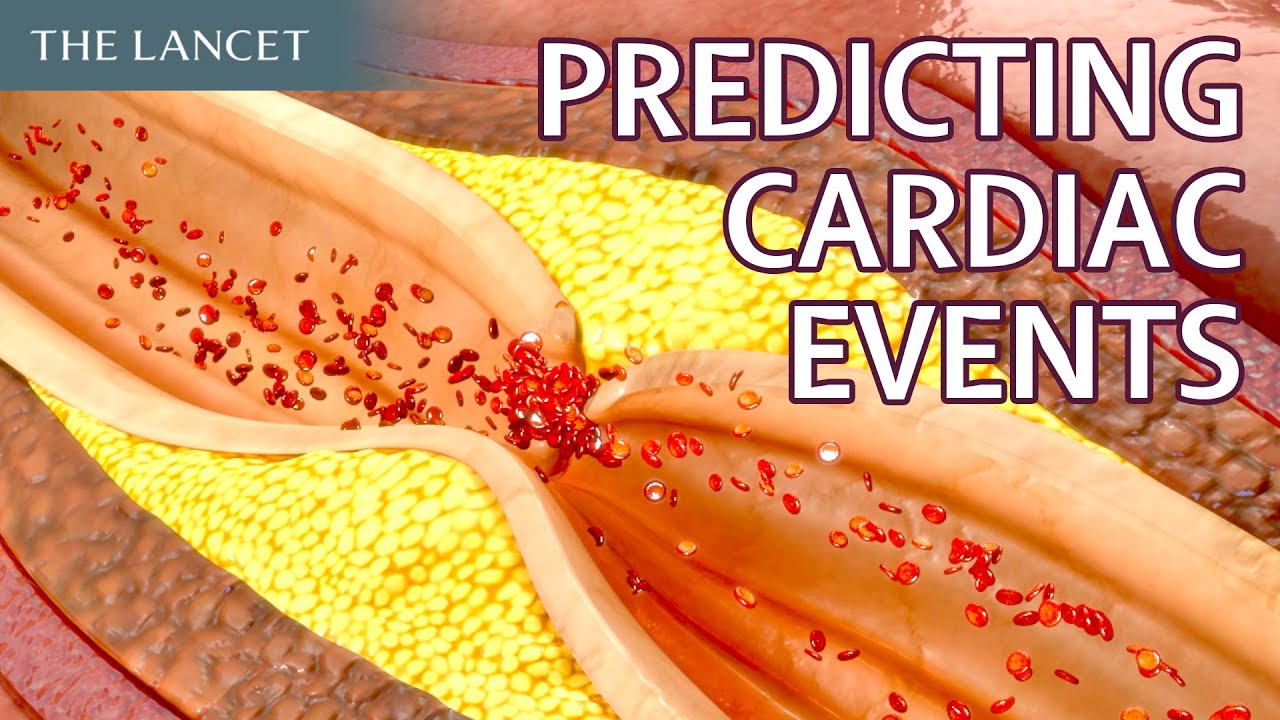 Inflammatoir risico voorspelt hartdood bij patiënten zonder obstructief coronairlijden